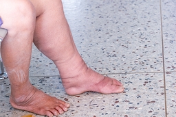 Neglected Tropical Diseases (NTDs): Elephantiasis