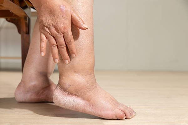 Swollen Feet: Don't Take It Lightly