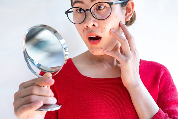 Ingin Kulit Bebas Jerawat? Lakukan Tips Berikut