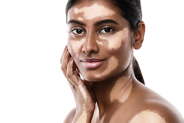 Understanding Vitiligo: When Skin Loses Its Color