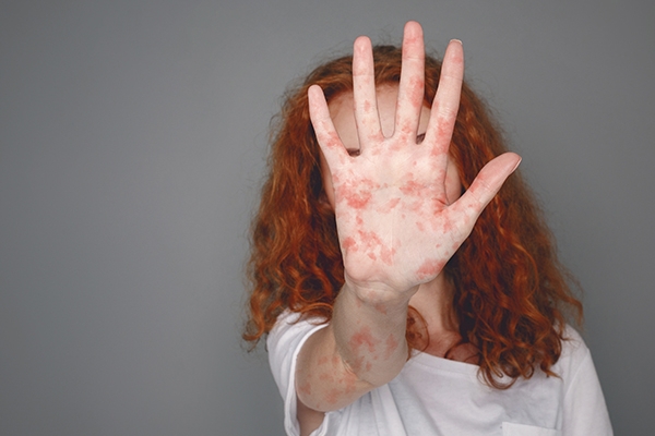 Measles Outbreak in Indonesia 2025: A Real Threat We Must Be Aware Of