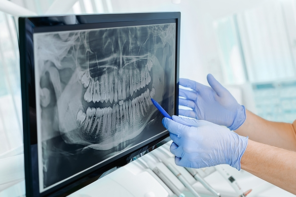 Kesehatan Gigi yang Komprehensif: Mengapa Dental Panoramic X-ray (OPG) Penting