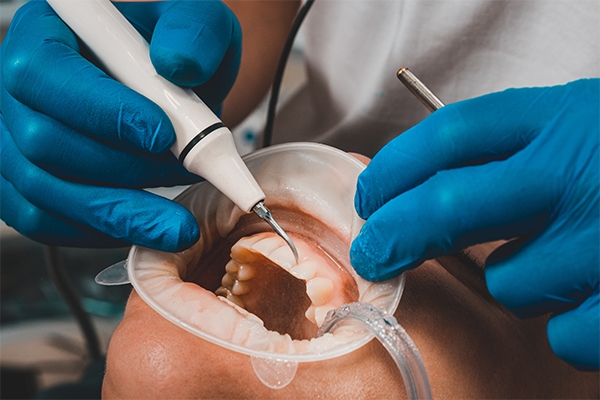 Scaling can remove dirt and plaque that cannot be cleaned with a toothbrush.