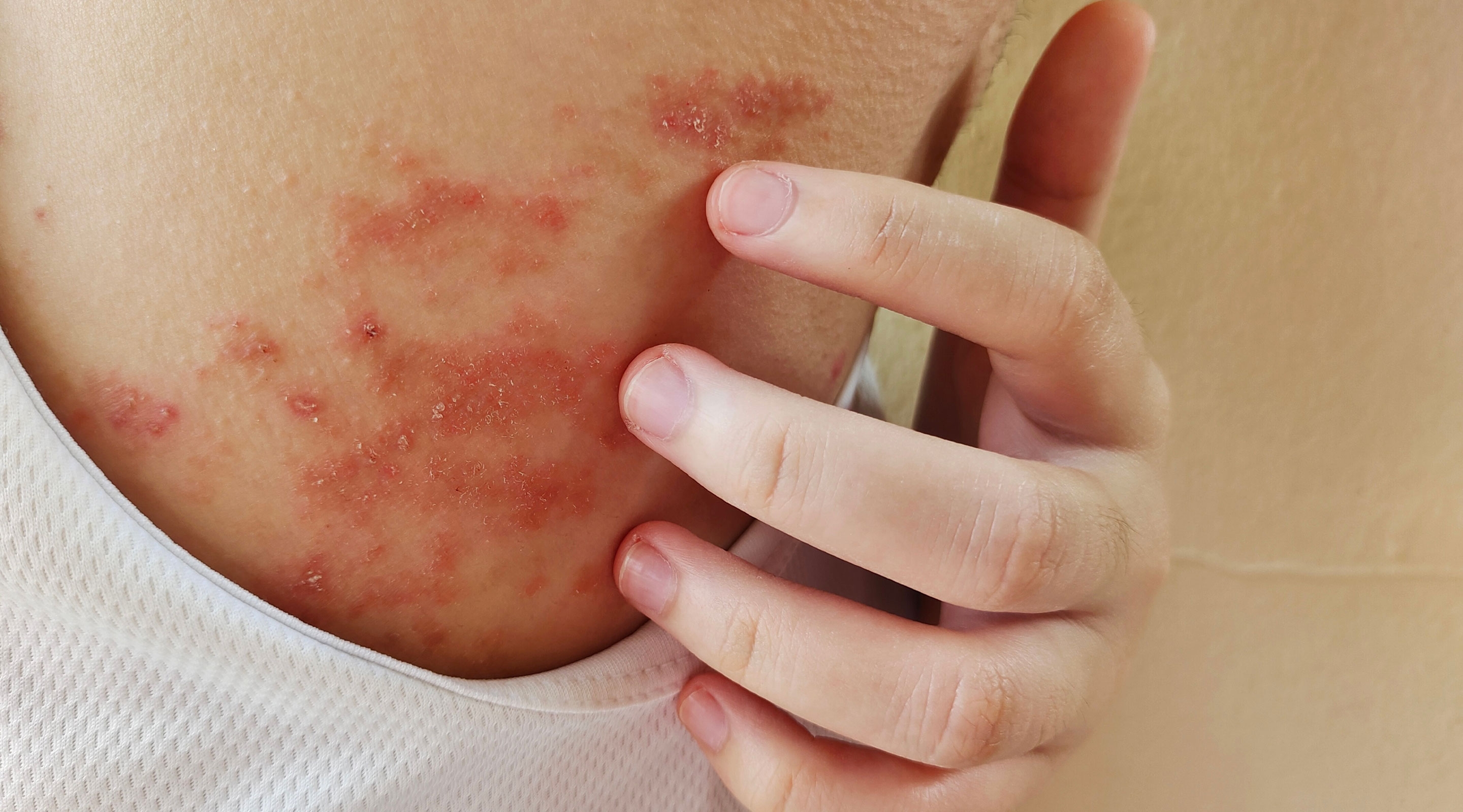 Salt triggers relapse of chronic skin diseases.