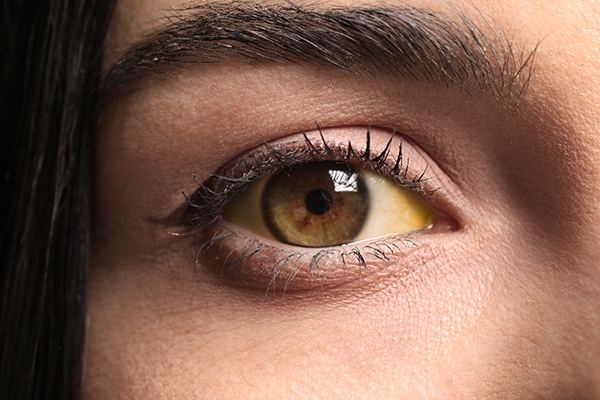 Pada kasus yang parah, yellow fever memiliki gejala kulit dan mata menguning.