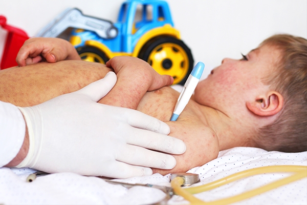 Early signs of measles include high fever and red, watery eyes.