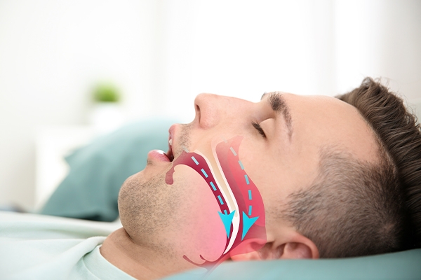 Causes of snoring.
