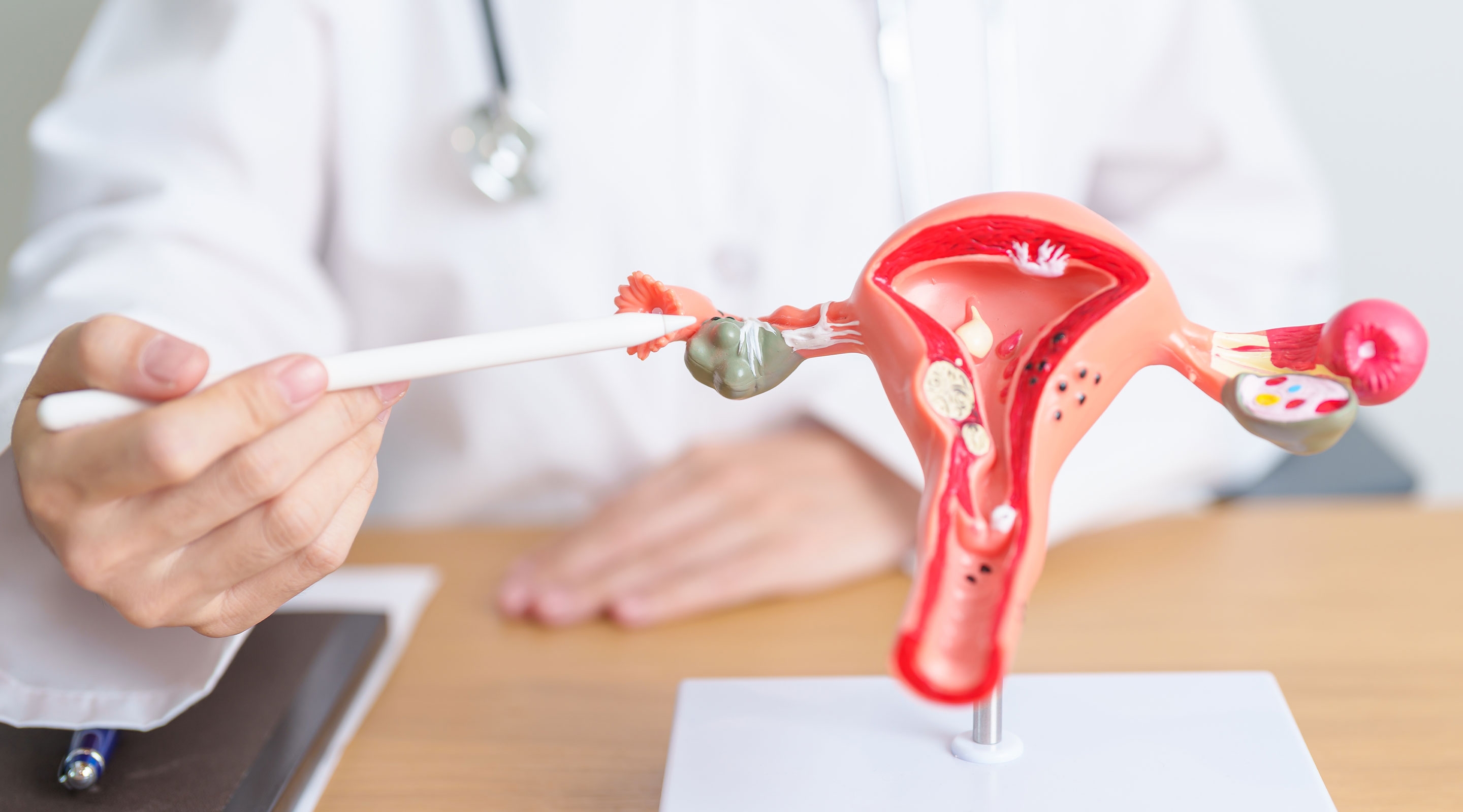 PCOS dapat dikelola dengan mengendalikan gejala dan mencegah komplikasi jangka panjang. 