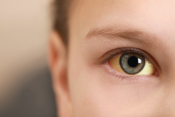 Yellowing of the skin and eyes (jaundice) is a common sign in people with hepatitis.