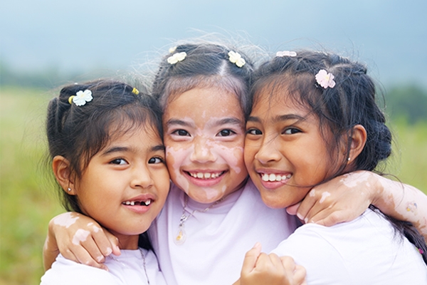 Vitiligo typically appears before the age of 30.