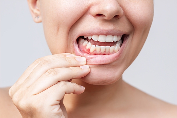 Neglecting dental and oral health can trigger gum disease.