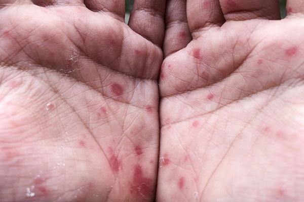 HFMD is characterized by blisters in the mouth, rashes, and red spots on the hands and feet.