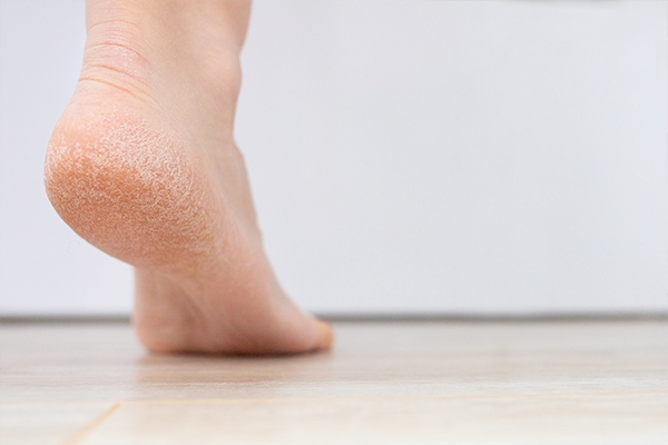 Vitamin B3 deficiency can cause cracked heels.