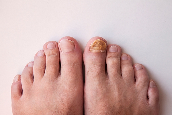 Fungal infection can cause toenails to turn yellow.