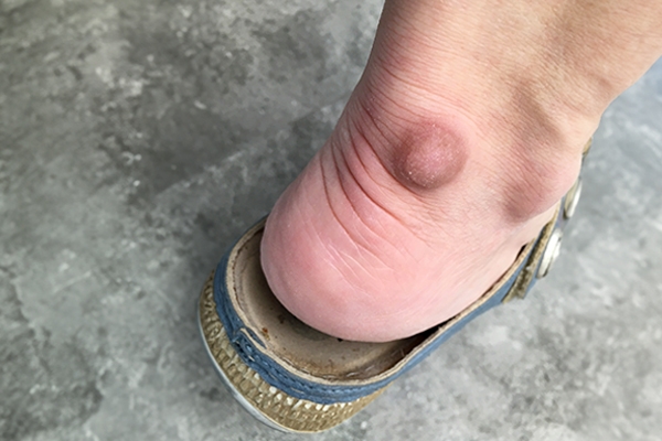 Eruptive xanthomatosis is more common in people with type 1 diabetes.