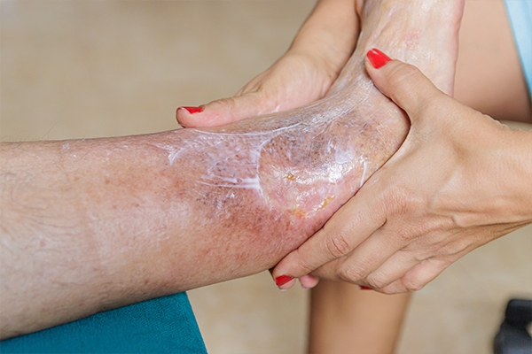 Brown patches on the shins indicate damage to small blood vessels.