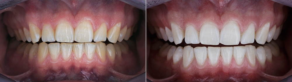 Before-after whitening