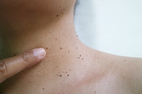 Skin tag bisa menjadi tanda resistensi insulin.