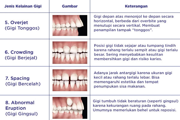 Dokter gigi akan merekomendasikan Anda perlu menggunakan behel atau tidak setelah mengetahui kondisi gigi Anda.