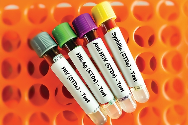 Melakukan tes PMS tidak hanya penting bagi kesehatan Anda, tetapi membantu melindungi pasangan dari risiko penularan. 